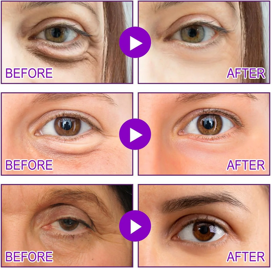 MicroNeedle Patches by NovaLift